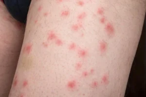 Early Signs of Bed Bugs